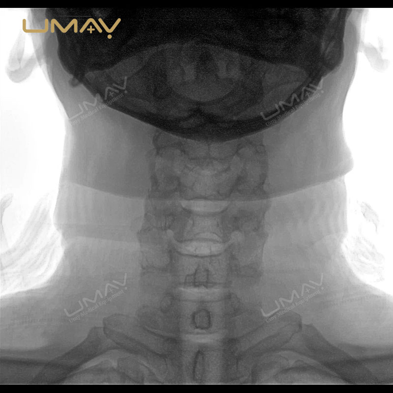 All-in-One Mobile C-Arm System with FPD for Orthopedics, Urology, and Gynecology