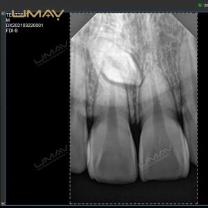 Portable Digital Dental X-ray Unit with Intraoral Radiography Sensor for Oral Treatment-2