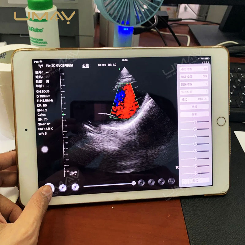 Wireless Phased Array Cardiac Ultrasound Probe for Echocardiography