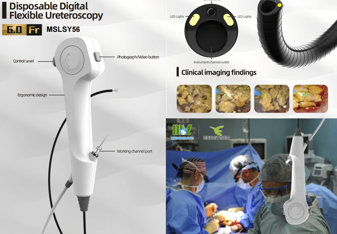 Highly Sought-After Flexible Disposable Electronic Ureteropelvic Endoscope