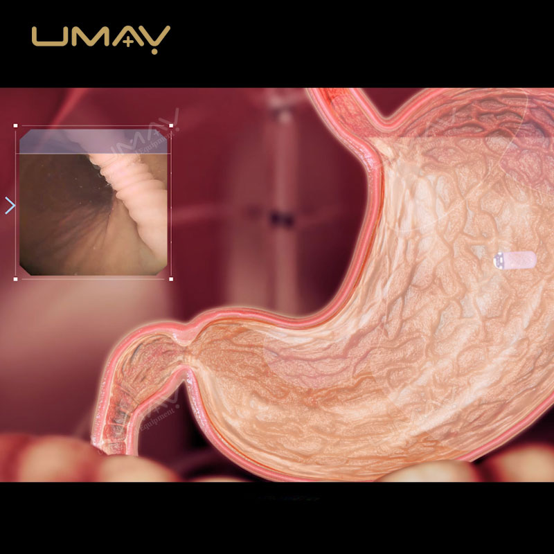 Wireless Capsule Endoscopy Innovative GI Tract Diagnostic System