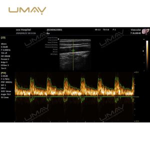 Ultra-thin B W ultrasound machine with real-time spatial compound imaging-6