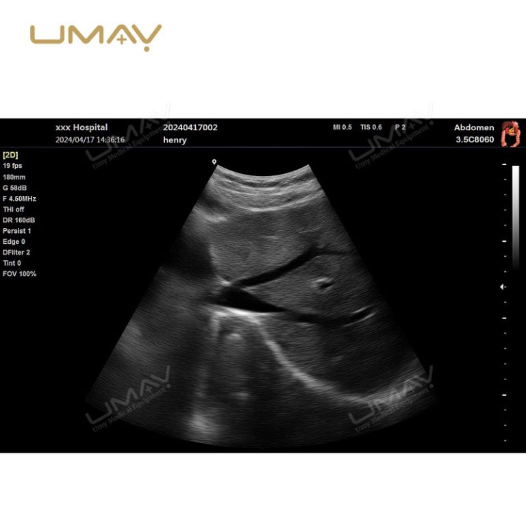 Ultra-thin B W ultrasound machine with real-time spatial compound imaging-7